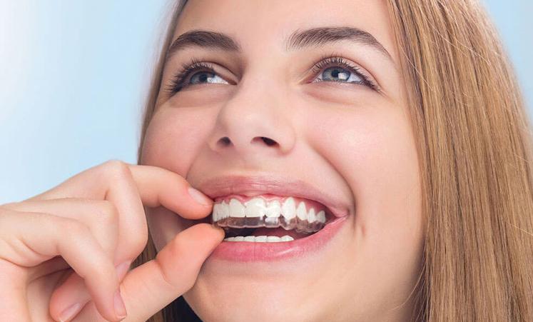 ClearCorrect clear aligners treatment at Bennett Family Dental in Westlake Ohio