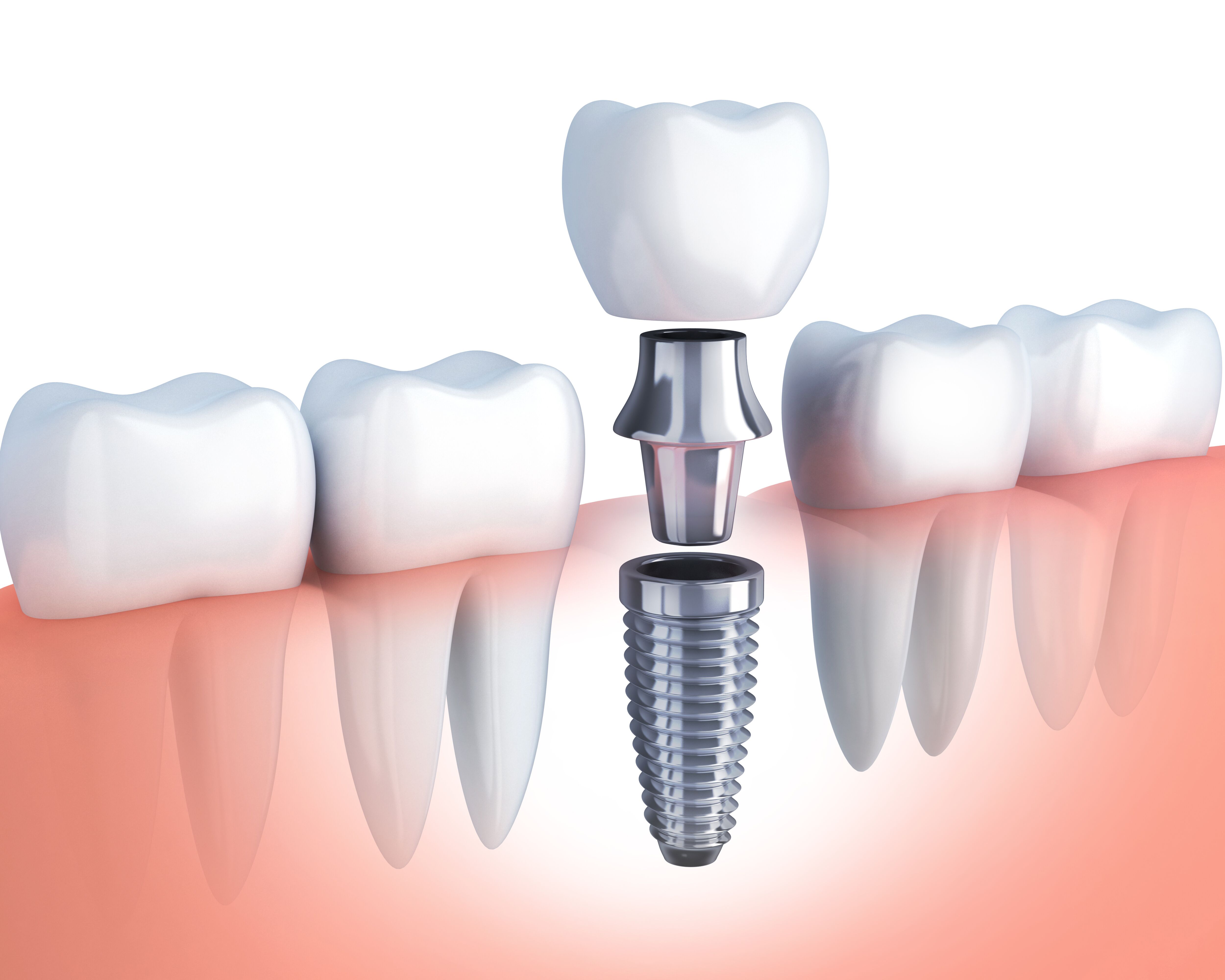 Dental implant tooth replacement at Bennett Family Dental in Westlake Ohio