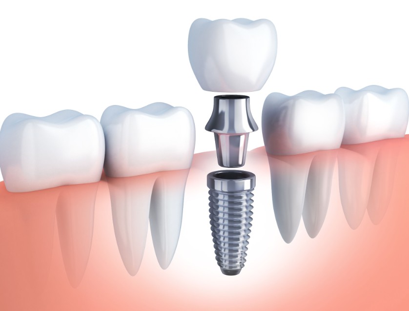 Post Op Instructions for Dental Implant: Recovery Guide for Better Healing