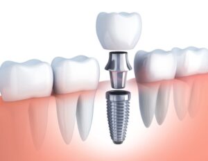 How Dental Implants Differ from Other Tooth Replacement Options