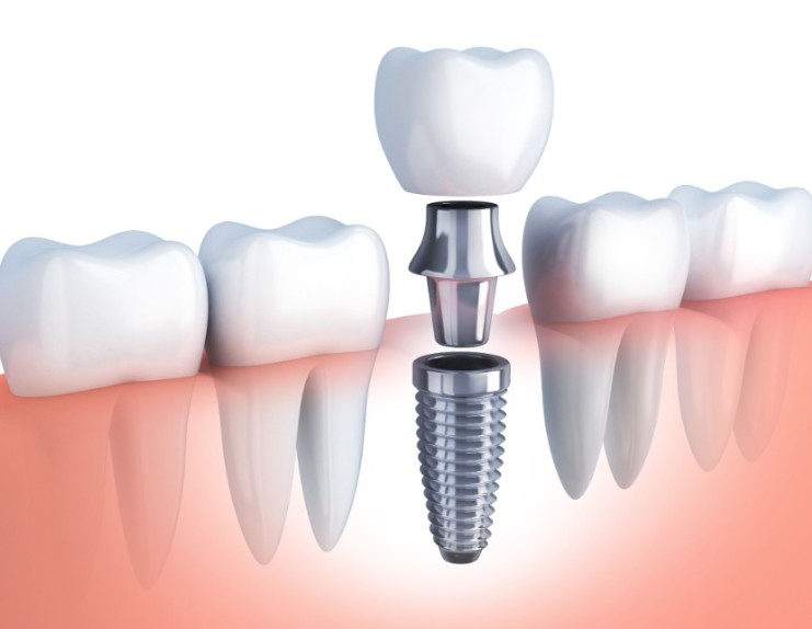 Single Tooth Implant Near Me: Choose Bennett Family Dental in Westlake, OH