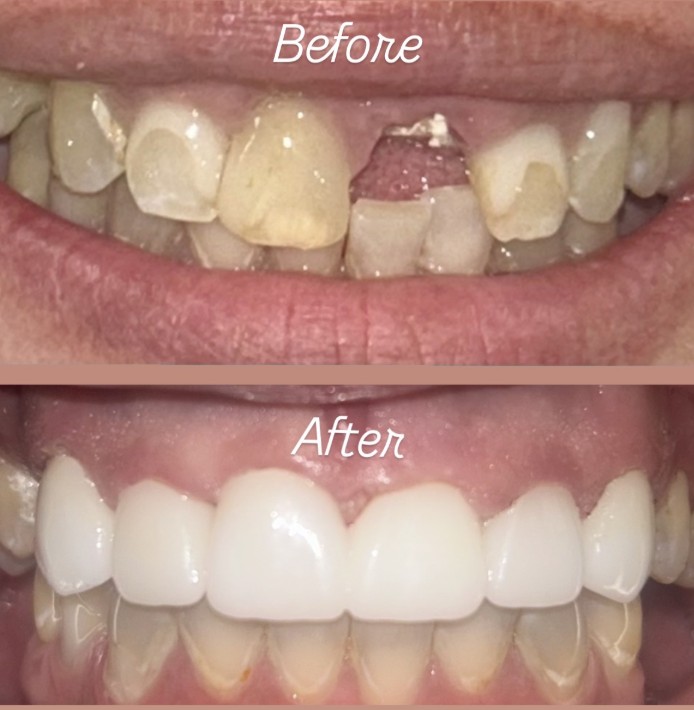 Teeth Whitening Cosmetic Dentistry: Options, Results, and How It Works