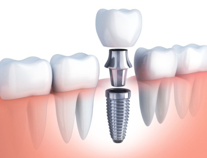 Dental Implant vs Bridge for One Missing Tooth: A Comparison