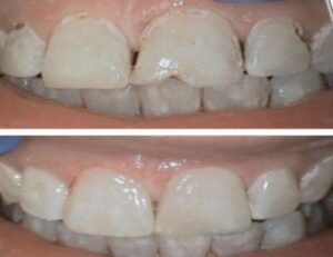 Foods and Drinks That Can Harm Your Teeth More Than You Realize
