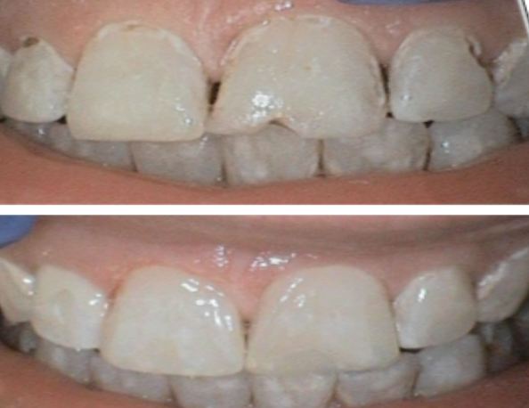 Foods and Drinks That Can Harm Your Teeth More Than You Realize