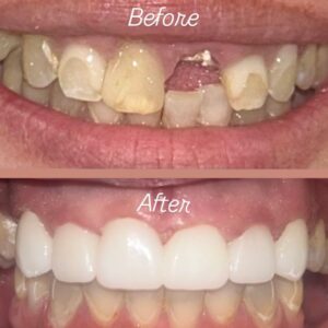 What Happens During Dental Implant Healing? A Timeline for Westlake Patients